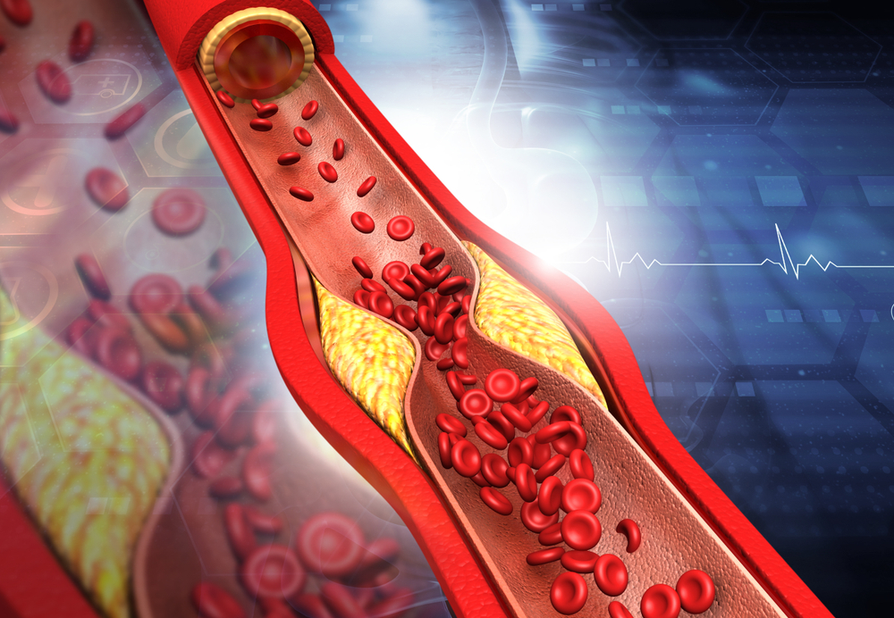 膽固醇對於血管的影響